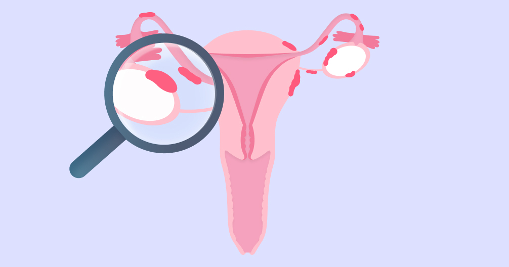 Illustration of the uterus and ovaries with endometriosis lesions, viewed through a magnifying glass