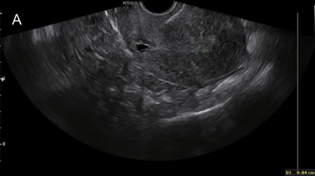 Transvaginal ultrasound scan of pelvic tissue with a 0.84 cm measurement